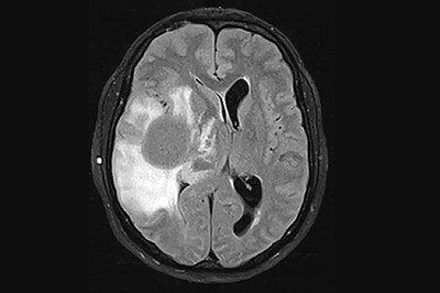 MRI image of diffuse glioma (top) © Universitätsmedizin Mannheim